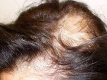 Выпадение волос – Алопеция